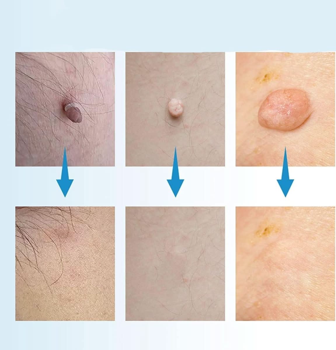 SPOTOFF - Skin Spot Remover for Easy and Targeted Use to Care for Skin Imperfections on the Body 1