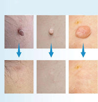 SPOTOFF - Skin Spot Remover for Easy and Targeted Use to Care for Skin Imperfections on the Body 1