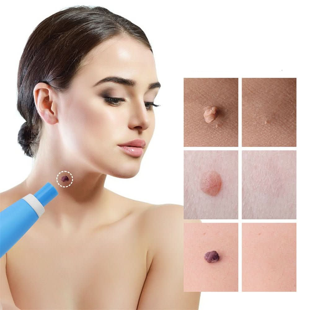 SPOTOFF - Skin Spot Remover for Easy and Targeted Use to Care for Skin Imperfections on the Body 5